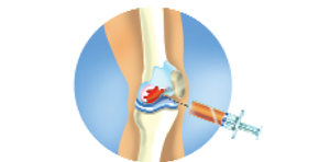 Injekce Orthokin koleno